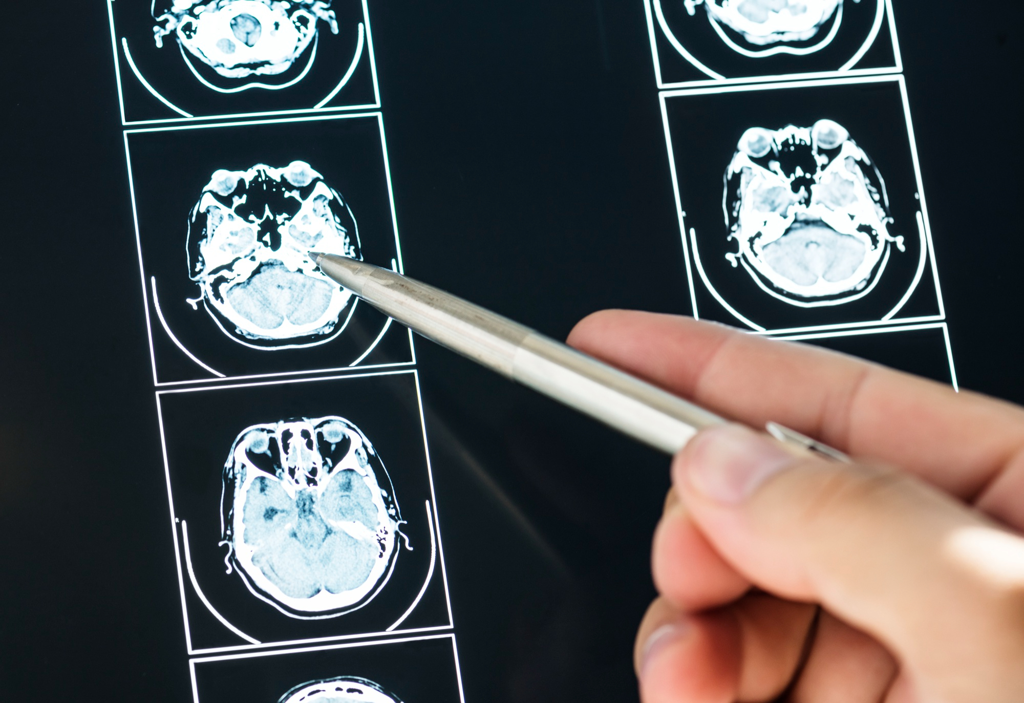 stroke คือ, เส้นเลือดในสมองแตก, เส้นเลือดในสมองตีบ, โรคหลอดเลือดสมอง